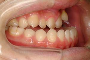 下顎前突症（上顎骨に対し下顎骨が前に出ている状態）の歯の例