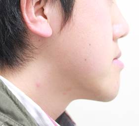 下顎前突症（上顎骨に対し下顎骨が前に出ている状態）の顔貌の例