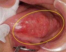 舌癌の例