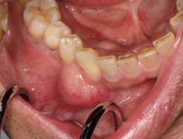 歯原性腫瘍