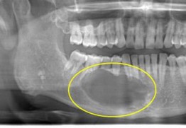 歯原性腫瘍のレントゲン