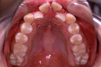 歯並びの乱れ上側