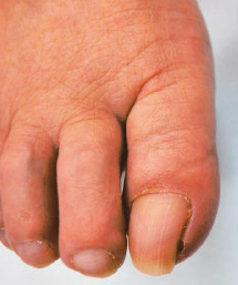 巻き爪の状態の右足の親指