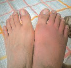 赤く腫れた状態の右足と腫れていない左足の比較