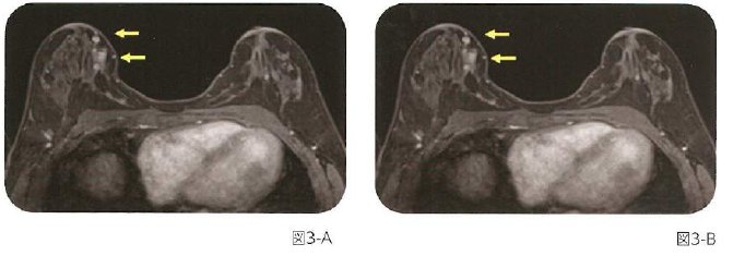 図3乳腺病変