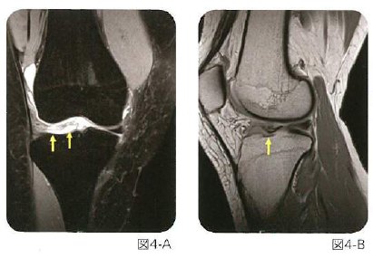 図4膝関節外傷