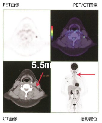 頸部の5.5mmという正常な大きさのリンパ節内のがん細胞が、PET/CT画像では明るく描出されている。