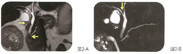図2胆のう腺筋症と胆のう管の合流異常
