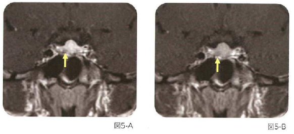 図5下垂体腺腫