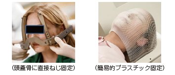 頭蓋骨に直接ねじ固定する状態の写真と簡易的プラスチック固定の状態の写真