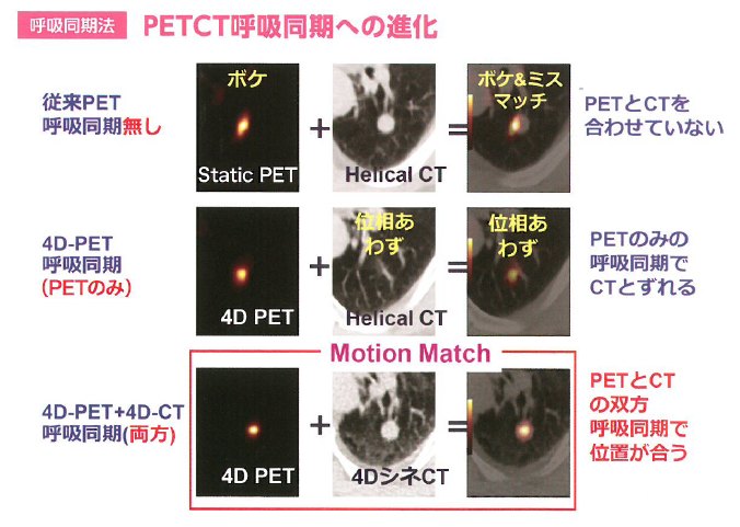 最新技術の呼吸同期法。PETCT呼吸同期への進化
